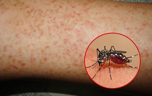 Nguyên nhân lây lan bệnh là do muỗi vằn truyền virus Dengue từ người bệnh sang người khỏe mạnh.