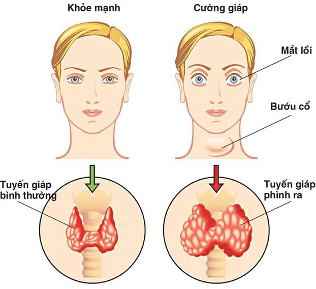 Những thay đổi trên cơ thể dự báo tuyến giáp có vấn đề.