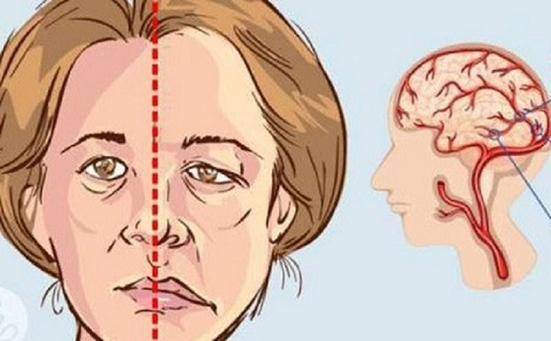 Khuôn mặt người bệnh trở nên buồn rầu, một phần hoặc một nửa khuôn mặt bị tê liệt, không cử động được.