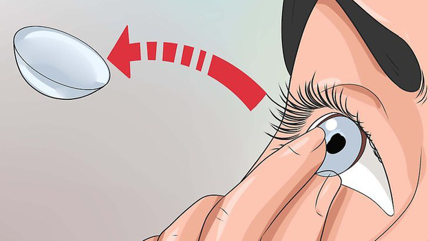 Kính áp tròng có thể là nguyên nhân gây kích ứng và đỏ mắt.