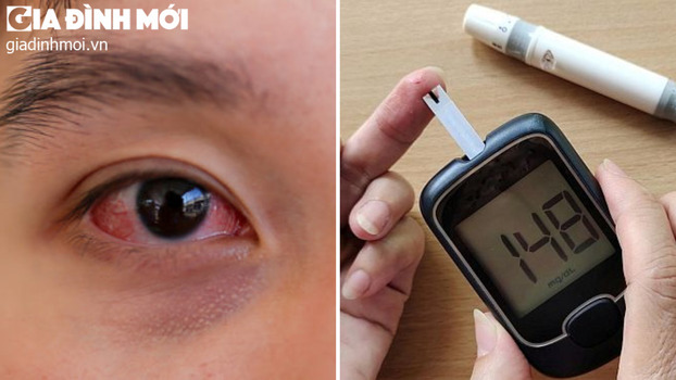 Khô mắt có thể là dấu hiệu cảnh báo bệnh tiểu đường