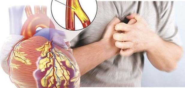 Đau thắt ngực là dấu hiệu cảnh báo bệnh mạch vành và một số bệnh lý tim mạch khác. Ảnh minh họa
