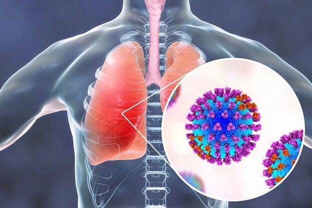 Virus RSV có thể gây viêm phổi, viêm tiểu phế quản nặng. Ảnh minh họa