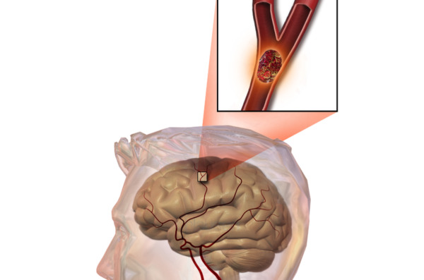 Ảnh minh họa: Huyết khối (cục máu đông) trong mạch máu não.