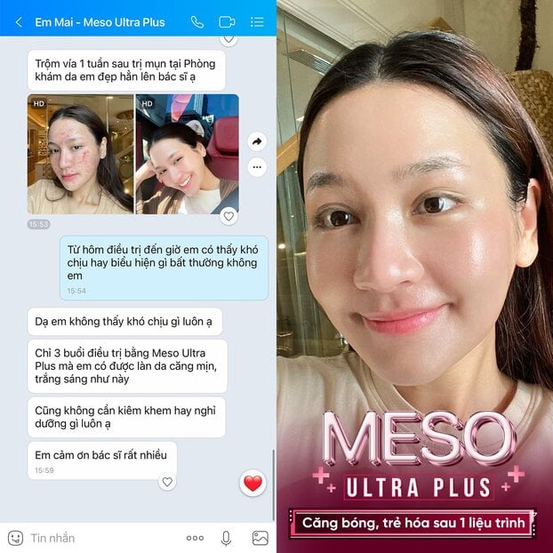 Phản hồi của khách hàng sau điều trị bằng Meso Ultra Plus