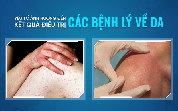 Yếu tố ảnh hưởng đến kết quả điều trị các bệnh lý về da