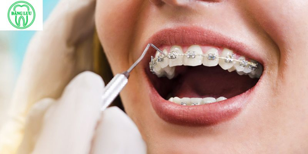 Tìm hiểu trước các phương pháp điều chỉnh răng