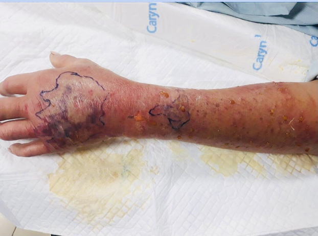 Cẳng tay trái bệnh nhân bị sưng nề, tấy đỏ, chảy dịch sau khi bị trẻ cắn