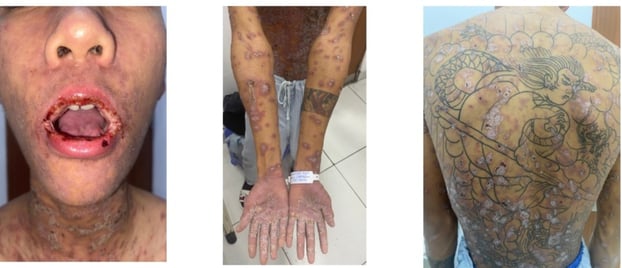 Bệnh nhân vào viện với biểu hiện loét trợt niêm mạc nặng và tổn thương da đa dạng với các sẩn, mảng đỏ tím, mụn nước, bọng nước rải rác toàn thân    
