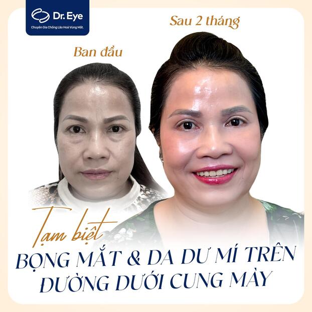 Một trường hợp chị H.P (53 tuổi, TP.HCM) tìm lại đôi mắt tự tin rạng rỡ sau phẫu thuật cắt bọng mắt dưới, cắt da dư mí trên đường dưới cung mày. (Nguồn hình: Dr. Eye)