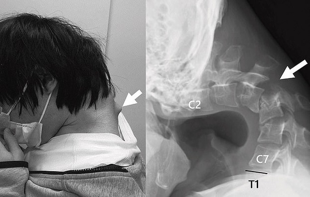 Hình ảnh chụp khám cho thấy khối phồng lên từ cổ của bệnh nhân. (Ảnh: Daily Mail)