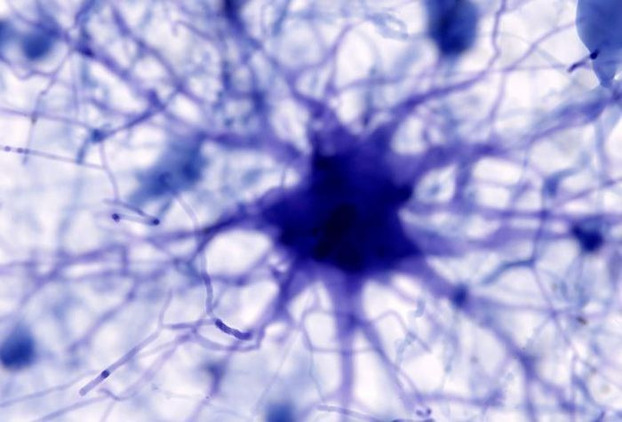 Alzheimer