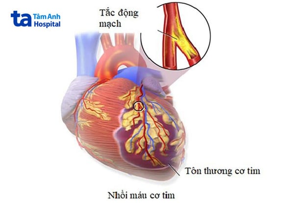 Nhoi mau co tim - 2