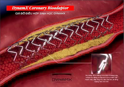 Cấu trúc đặc biệt với các khớp nối tự tách giúp stent tương thích sinh học thế hệ mới DynamX Bioadaptor “giải phóng” mạch máu sau can thiệp