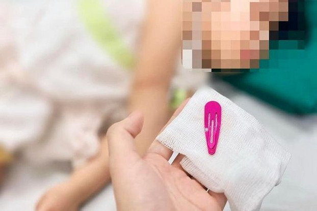 Chiếc kẹp tóc được lấy ra từ dạ dày của bệnh nhi. Ảnh: BVCC