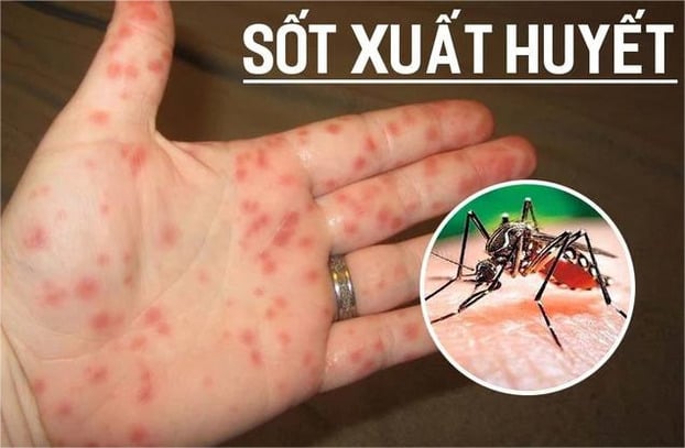 Sốt xuất huyết là căn bệnh nguy hiểm thường xuất hiện ở các quốc gia vùng nhiết đới như Việt Nam - ảnh minh họa.