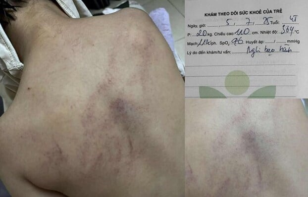 Những vết bầm tím trên cơ thể bé Trịnh Kim L khi bị bạo hành tại Trường mầm non Gia Thụy - ảnh: Gia đình cung cấp