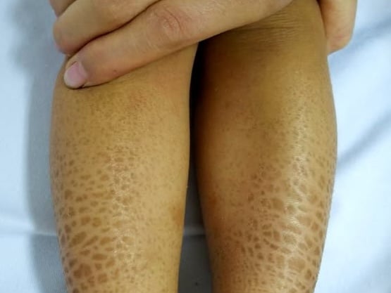 Bệnh vảy cá bẩm sinh biểu hiện bằng khô da, bong vảy lan tỏa