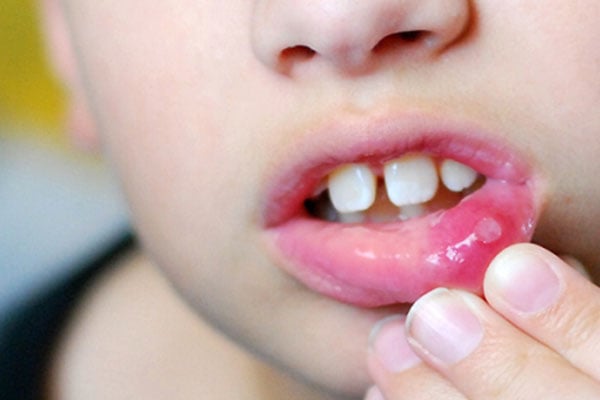Lở miệng hay còn gọi là loét miệng, một bệnh phổ biến gặp ở mọi đối tượng