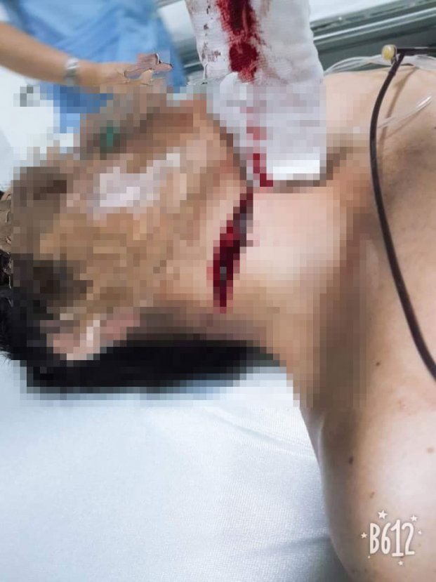   Hình ảnh vết thương của nạn nhân trong vụ việc xảy ra hôm qua tại Cà Mau  