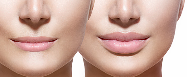   Đôi môi trước và sau khi bơm môi.  