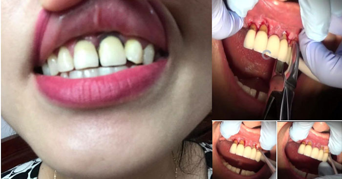 Tháng 8/2017, trên mạng xã hội xuất hiện 1 video hỏng răng vì bọc sứ thẩm mỹ khiến nhiều người lo lắng