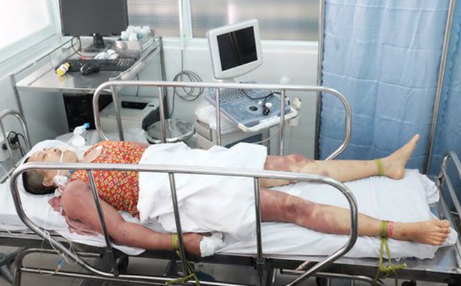 bệnh nhân nhập viện vì bị thầy cúng dùng 27 chiếc roi dâu đánh liên tục