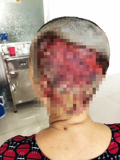 Bệnh nhân L. bị bỏng nặng, hoại tử da đầu và có nguy cơ không thể mọc lại tóc