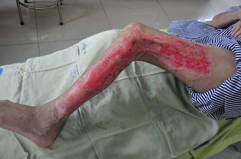 Chân bị biến chứng của một bệnh nhân mắc bệnh đái tháo đường.
