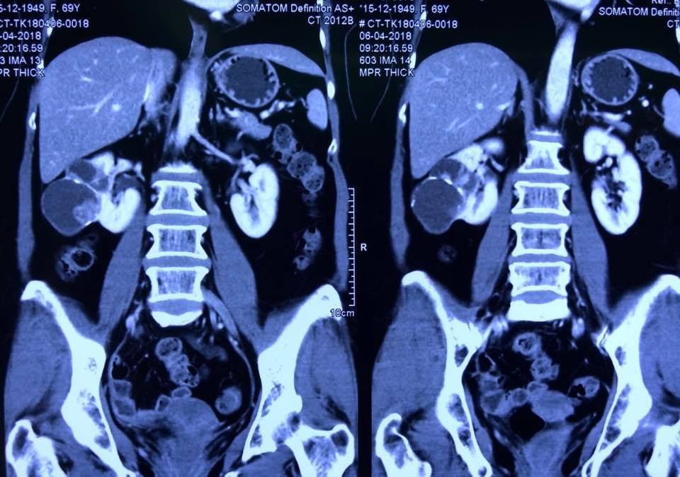 Hình ảnh chụp CT khối u thận của bệnh nhân