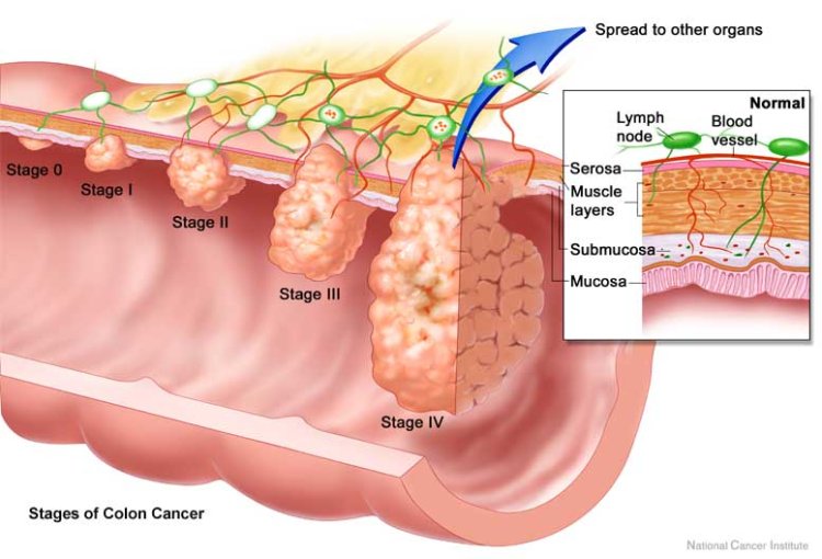 Những giai đoạn phát triển của ung thư đại trực tràng