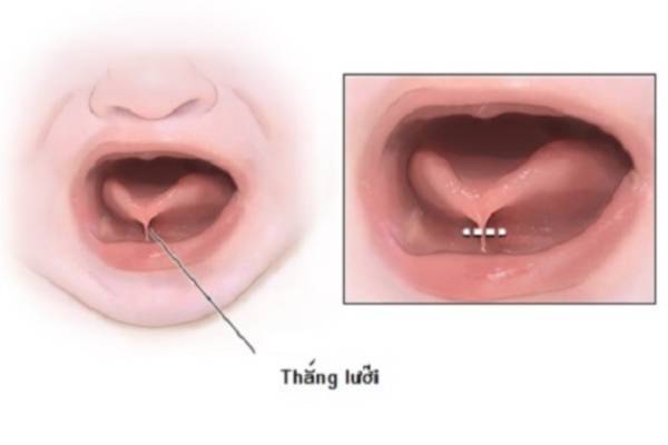 Trẻ bị dính thắng lưỡi nếu không phát hiện sớm cũng có thể gây khó khăn cho việc phát âm về sau của trẻ