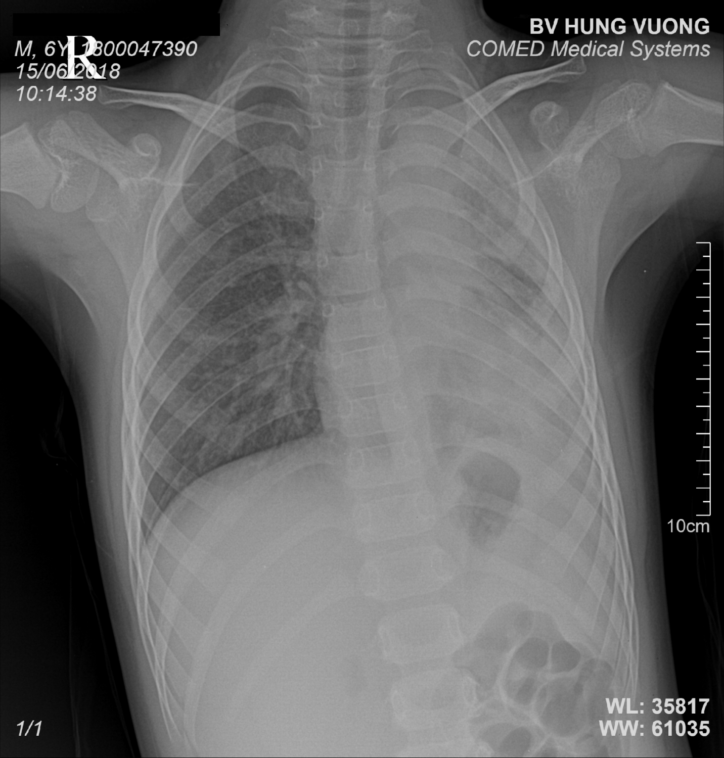 Hình ảnh XQ phổi cho thấy nhu mô phổi bên trái của trẻ bị xẹp