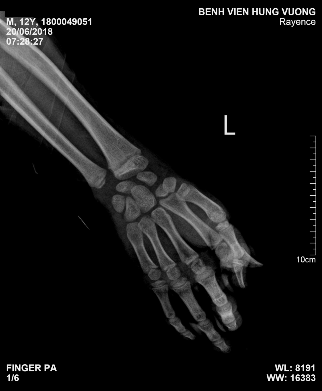 Kết quả chụp XQ cho thấy hình ảnh khuyết bán phần đốt gần xương ngón hai bàn tay trái.  