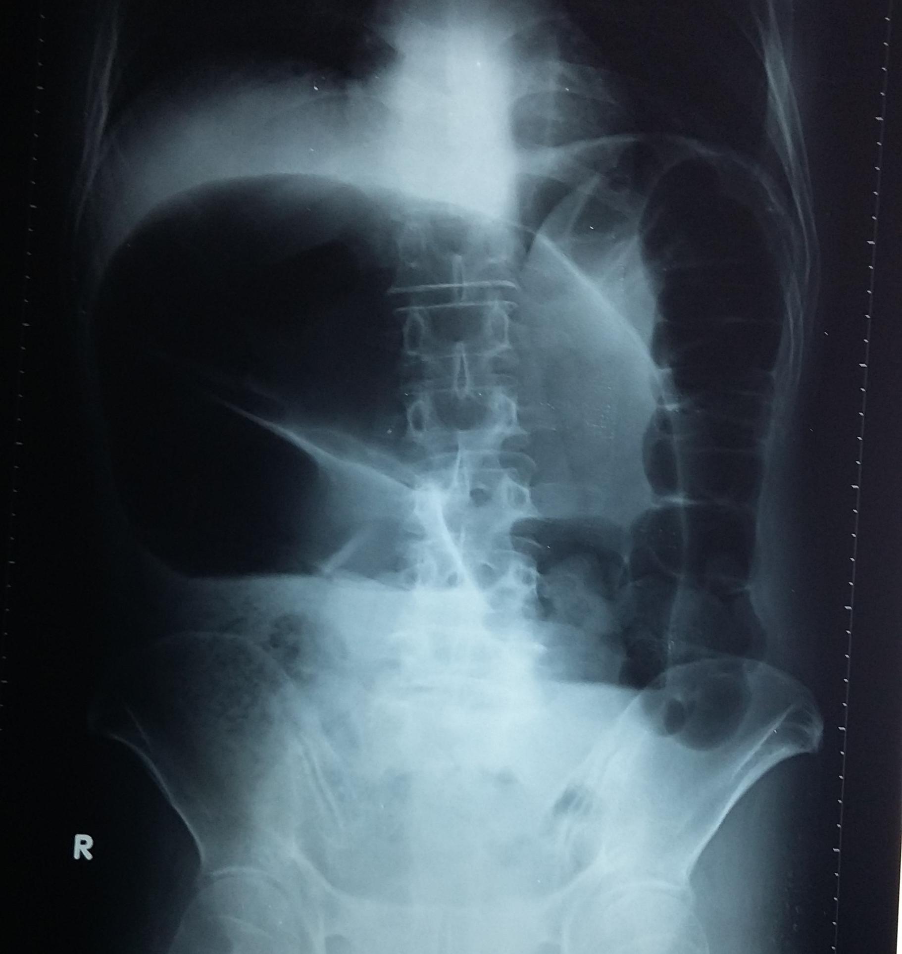 Hình ảnh Xquang cho thấy bệnh nhân bị xoắn ruột