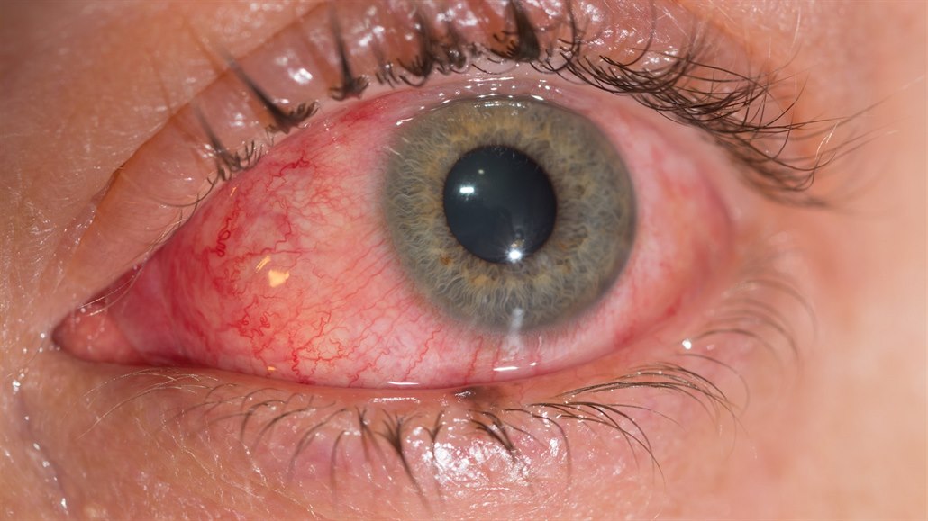 Kính tiếp xúc có thể hạn chế các tổn thương ở mắt như xuất huyết, rách giác mạc...