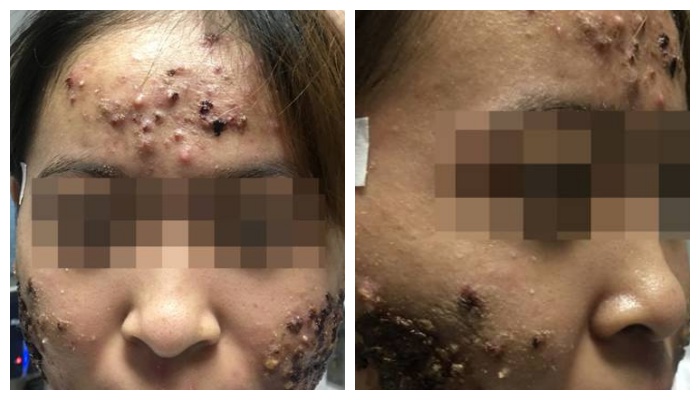 Tình hình da mặt của thiếu nữ sau khi trị trứng cá tại một phòng khám tư