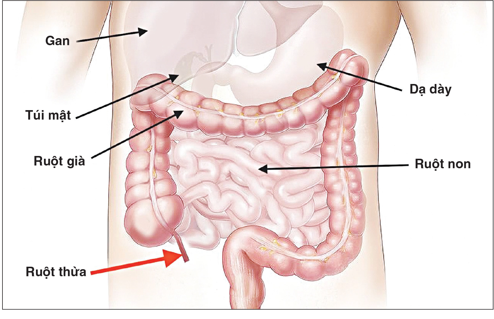 Vì bất cứ lí do nào, nếu ruột bị tắc, xoắn khiến máu không đến nuôi hoặc viêm nhiễm quá mức có thể dẫn đến hoại tử ruột