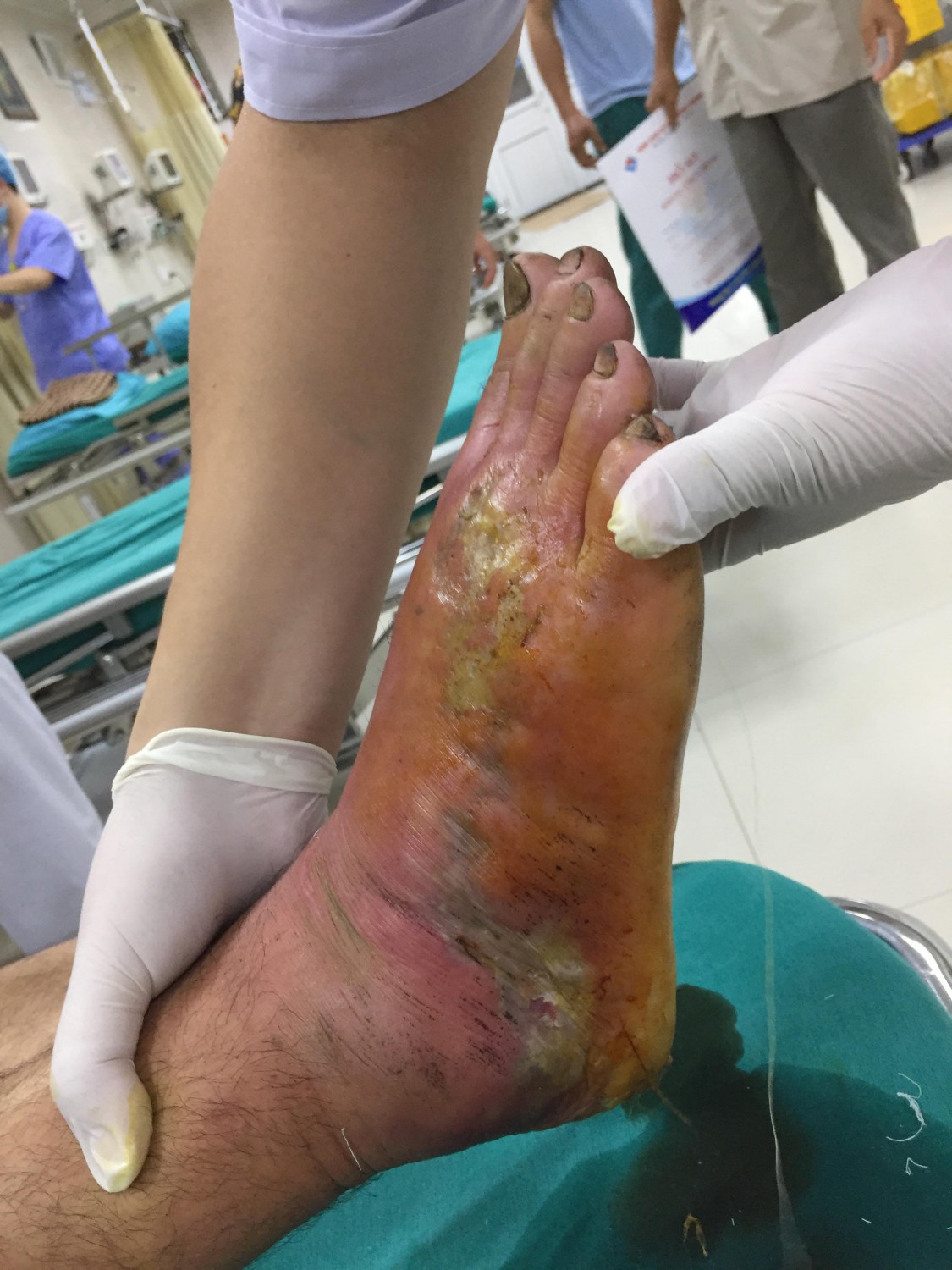 Bàn chân bệnh nhân khi nhập viện