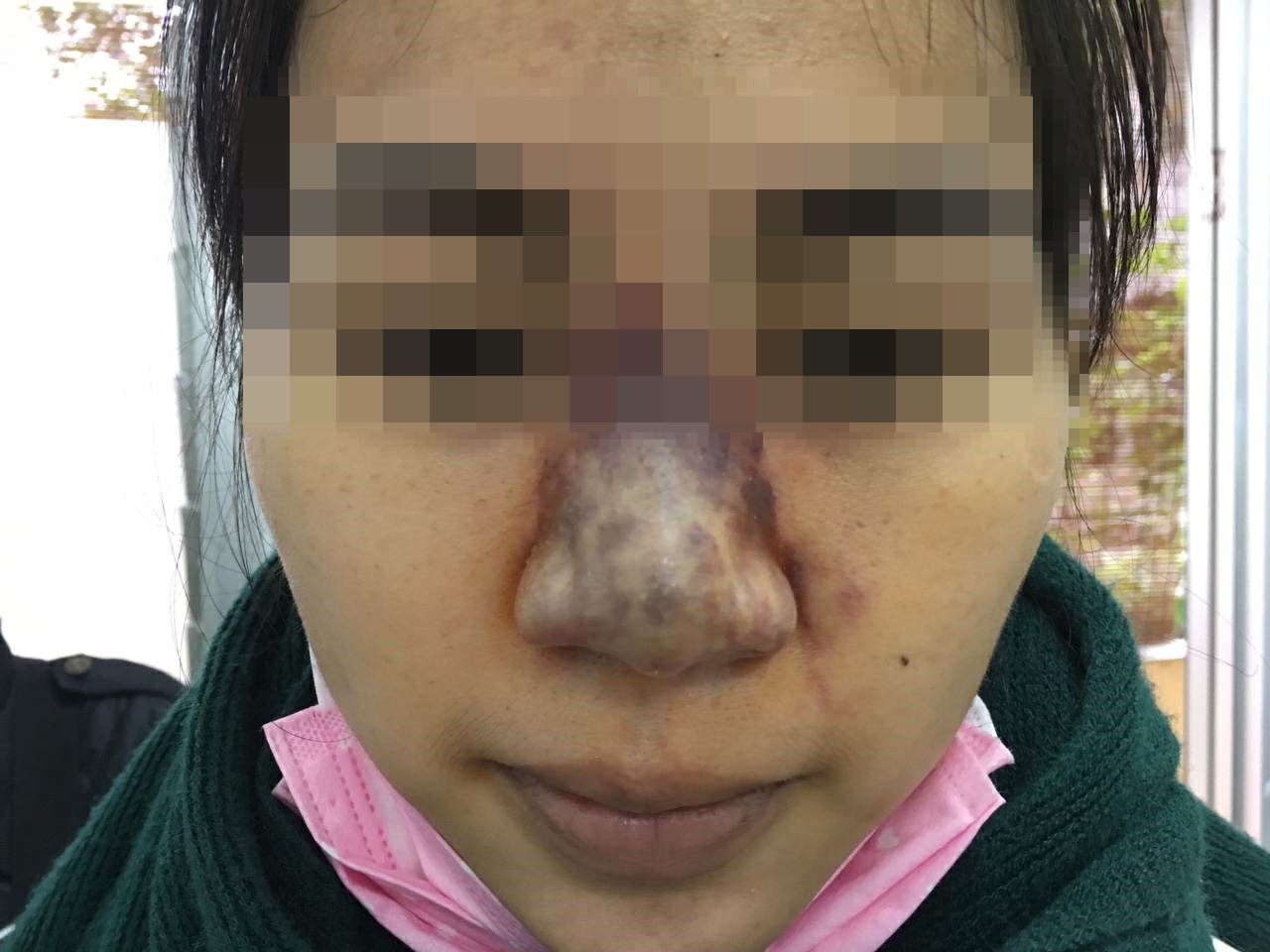 Hình ảnh một nạn nhân hoại tử mũi vì tiêm Filler