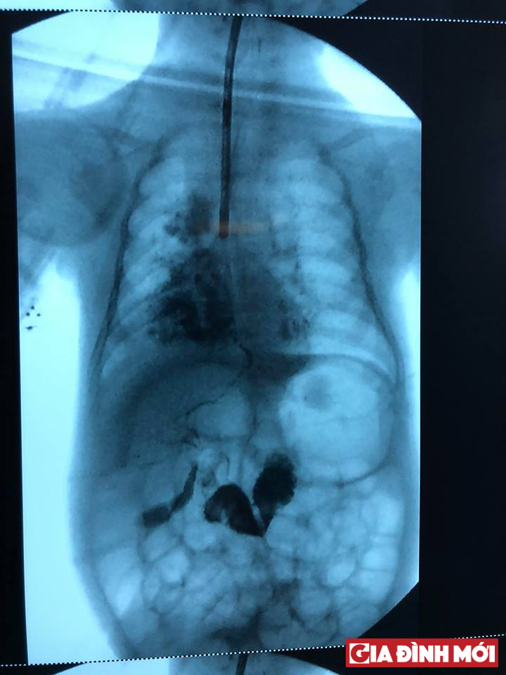 Hình ảnh đường rò gây ra bệnh lý viêm phổi của bé