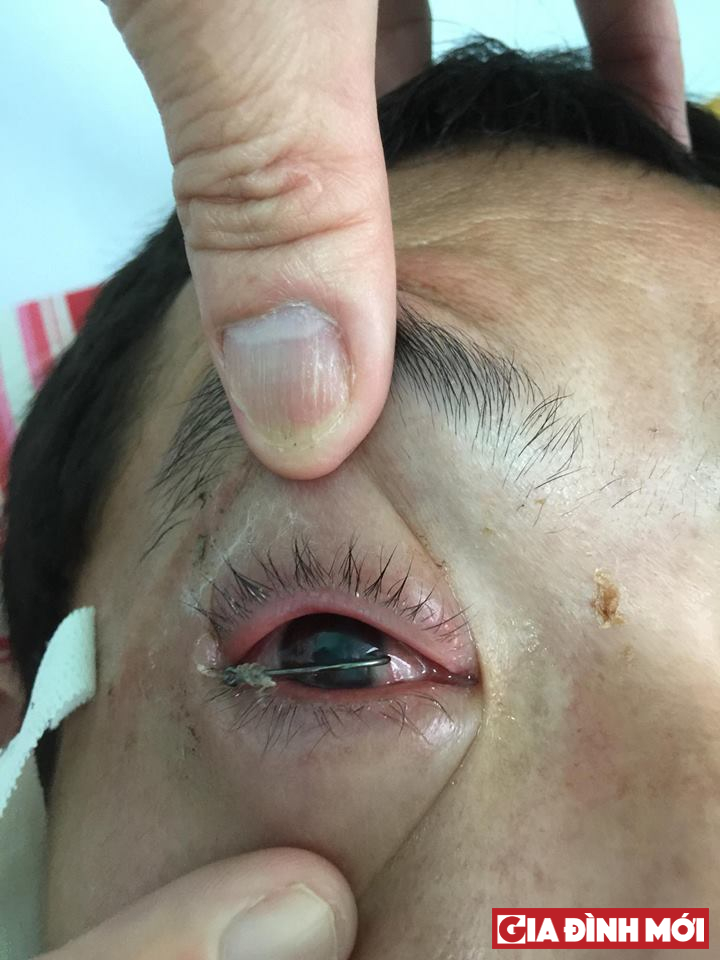 Móc câu móc vào mắt trái bệnh nhân