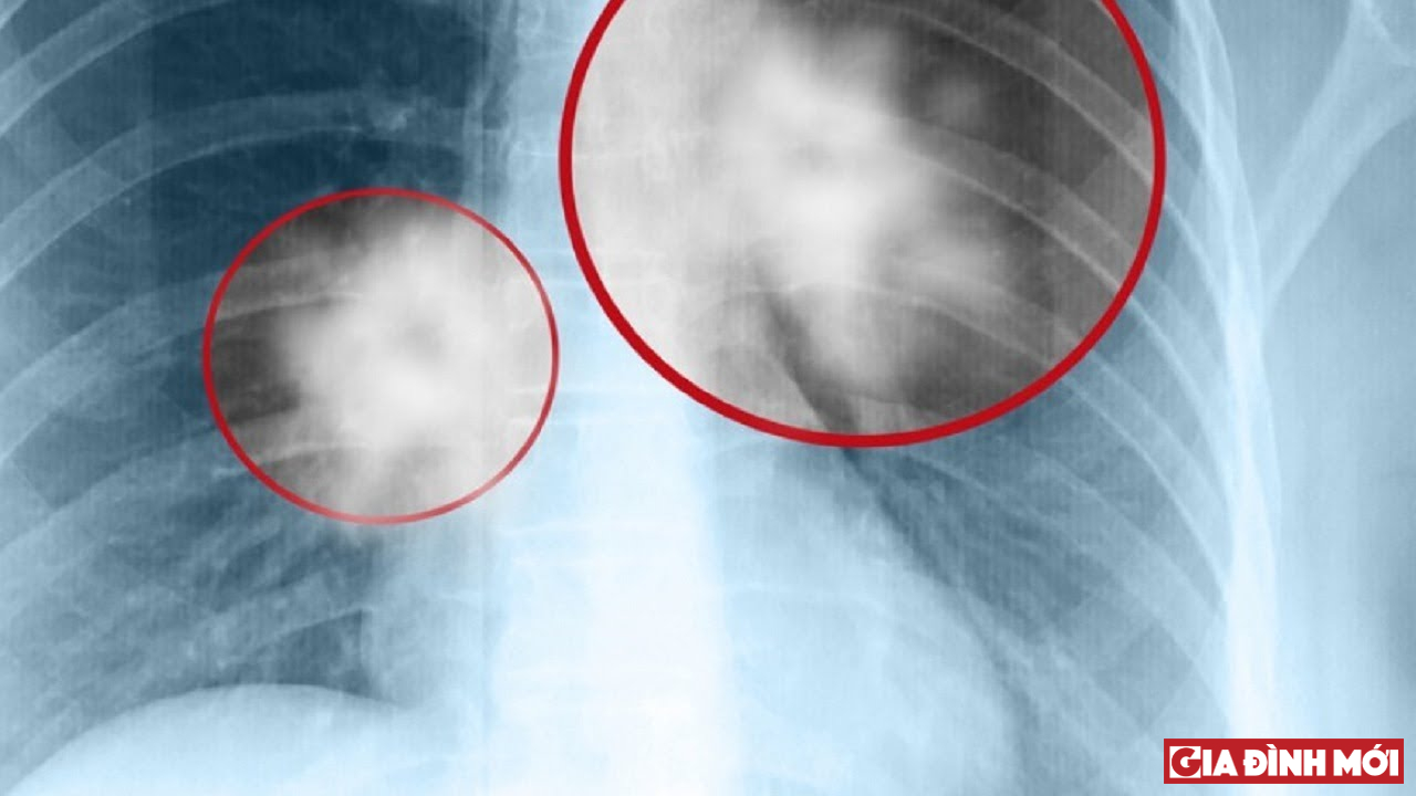 Khi có những biểu hiện bất thường như ho dai dẳng, ho ra máu... người bệnh nên chụp X- quang phổi để kiểm tra