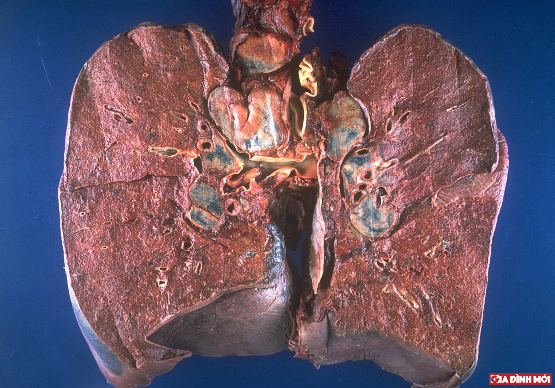 Lá phổi bị ung thư sẽ có hình dạng như trên