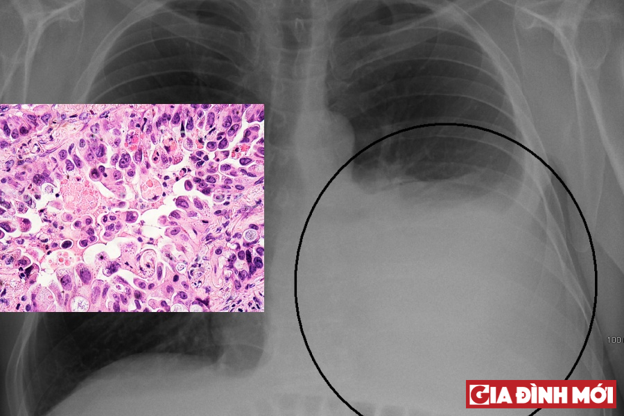 Hình ảnh sinh thiết ung thư phổi