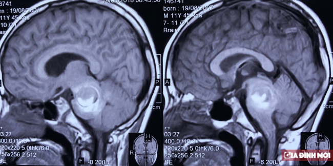   Hình ảnh CT u thân não cháy máu của trẻ  