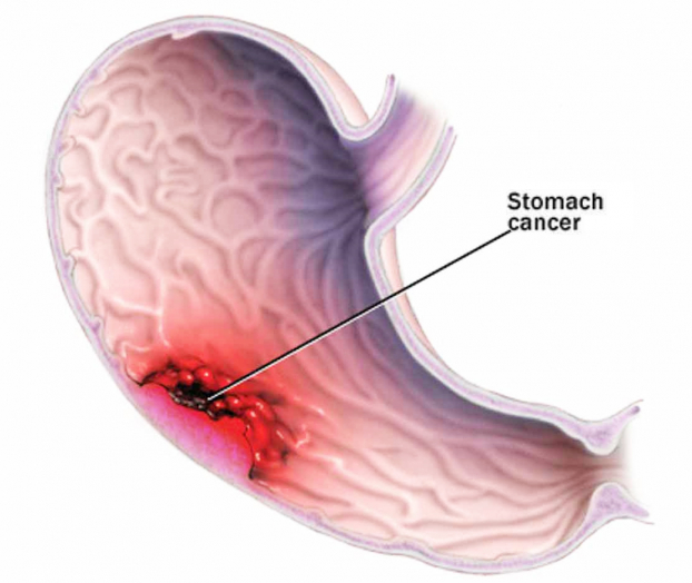   Hình ảnh mô tả tế bào ung thư phát triển trong dạ dày.  
