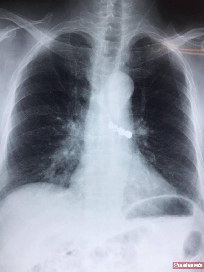   Hình ảnh chụp Xquang phổi cho thấy, 4 chiếc răng đang nằm trong phế quản bệnh nhân  