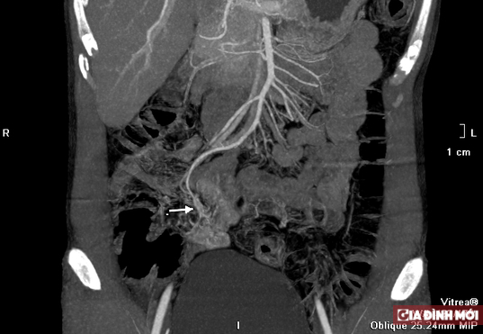   Hình ảnh cho thấy có một búi dị dạng mạch máu từ một nhánh của động mạch mạc treo tràng trên  