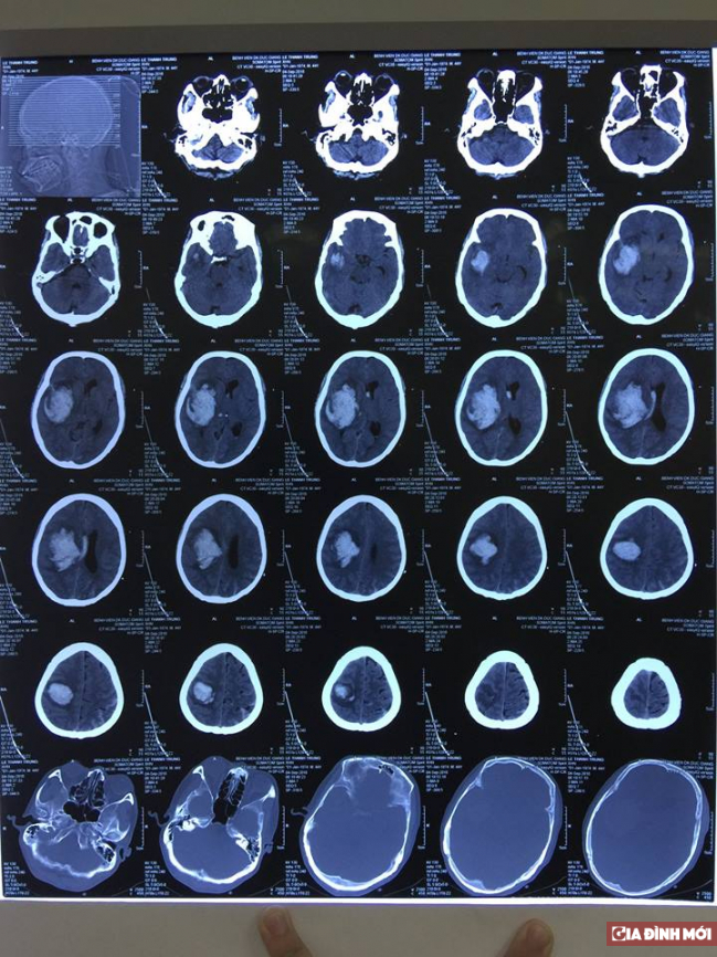   Hình ảnh CT não cho thấy bệnh nhân có khối máu tụ  